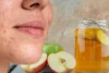 Salah Satu Bahan Alami Perawatan Kulit, Ini Manfaat Cuka Apel